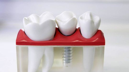 Chirurgiens-Dentistes à Bordeaux Implant Dentaire