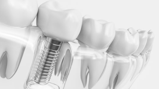 Implant Chirurgiens Dentistes Bordeaux